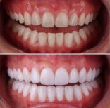 Before and after Hollywood Smile veneers at Dentavie Istanbul Dental Clinic, smile makeover result