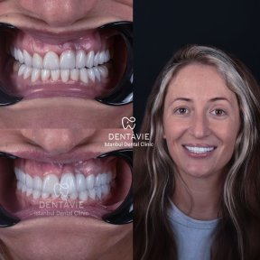 Hollywood Smile Vorher-Nachher-Ergebnisse bei Dentavie Istanbul Dental Clinic, Smile Makeover