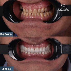 Before and after Hollywood Smile results at Dentavie Istanbul Dental Clinic, smile makeover
