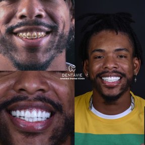 Hollywood Smile before and after results at Dentavie Istanbul Dental Clinic, smile makeover