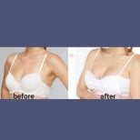 Before and after breast augmentation results at ID Clinic Bangkok, enhanced breast volume