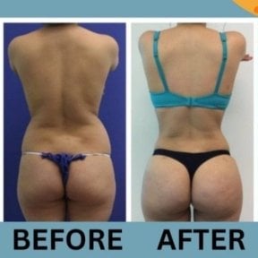 Before and after Vaser liposuction results at ID Clinic Bangkok, improved waist and contour