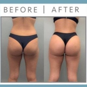 Before and after Vaser liposuction results at ID Clinic Bangkok, enhanced body contour