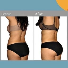 Before and after Vaser liposuction results at ID Clinic Bangkok, improved body contour