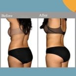 Before and after Vaser liposuction results at ID Clinic Bangkok, improved body contour