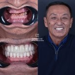 Before and after All-on-6 dental implants result at Dentavie Istanbul Dental Clinic, smile restored