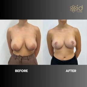 Before and after breast reduction results at ID Clinic Bangkok, improved breast shape and size