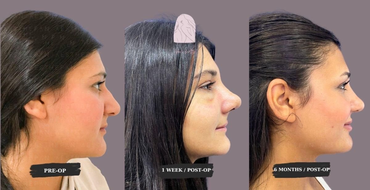 نتائج تجميل طرف الأنف قبل وبعد في Dr. MED – تحسين شكل ومظهر الأنف