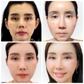Before and after lipofilling results at Wansiri Hospital, facial fat grafting for rejuvenation