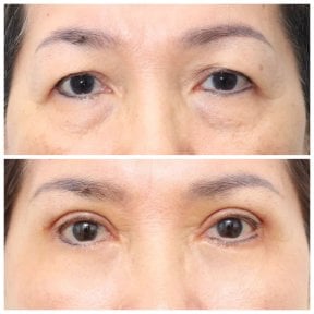Before and after lipofilling under eyes at Wansiri Hospital, reduced eye bags and smoother skin