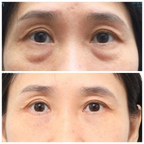 Before and after lipofilling under eyes at Wansiri Hospital, reduced eye bags result