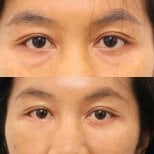 Before and after lipofilling under eyes at Wansiri Hospital, reduced dark circles result