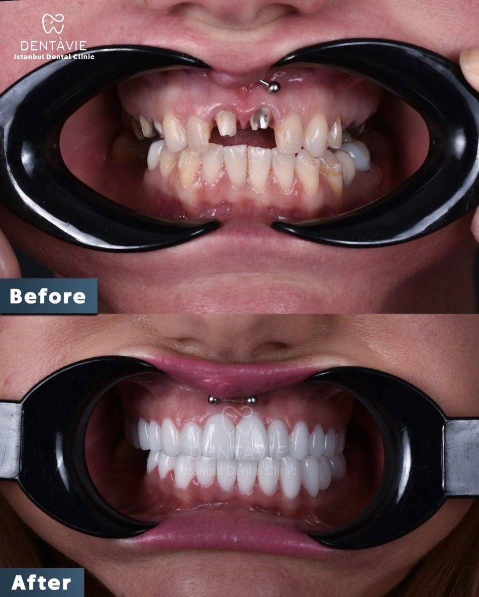 Resultados antes y después de implantes dentales en Dentavie Istanbul Dental Clinic, sonrisa restaurada