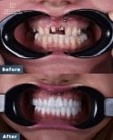 Before and after dental implant results at Dentavie Istanbul Dental Clinic, restored smile