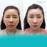 Before and after Fox Eye Lift results at Wansiri Hospital, enhanced eye contour and lift