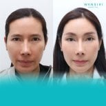 Before and after Fox Eye Lift results at Wansiri Hospital, enhanced eye contour and lift