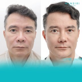 Fox Eye Lift before and after results at Wansiri Hospital – rejuvenated eye area appearance
