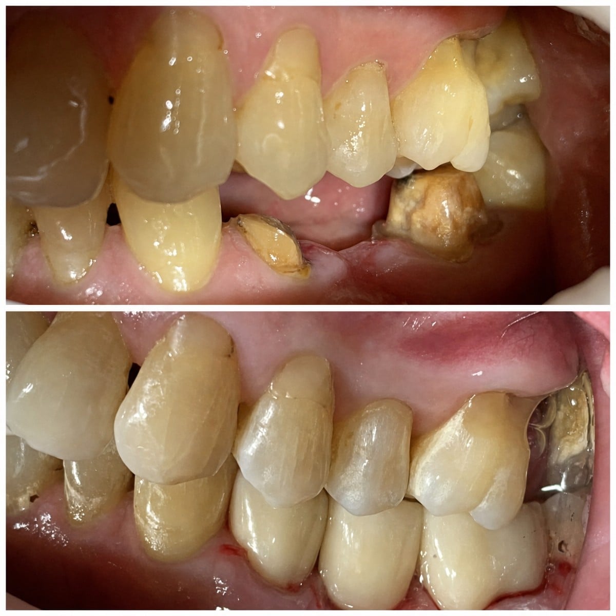 Resultados de mini implante dental antes y después en Smile Terminal Dental Care, mejor alineación