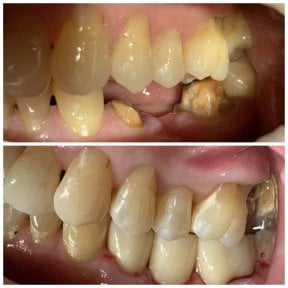 Результати міні-імплантації зубів до і після у Smile Terminal Dental Care, покращення прикусу