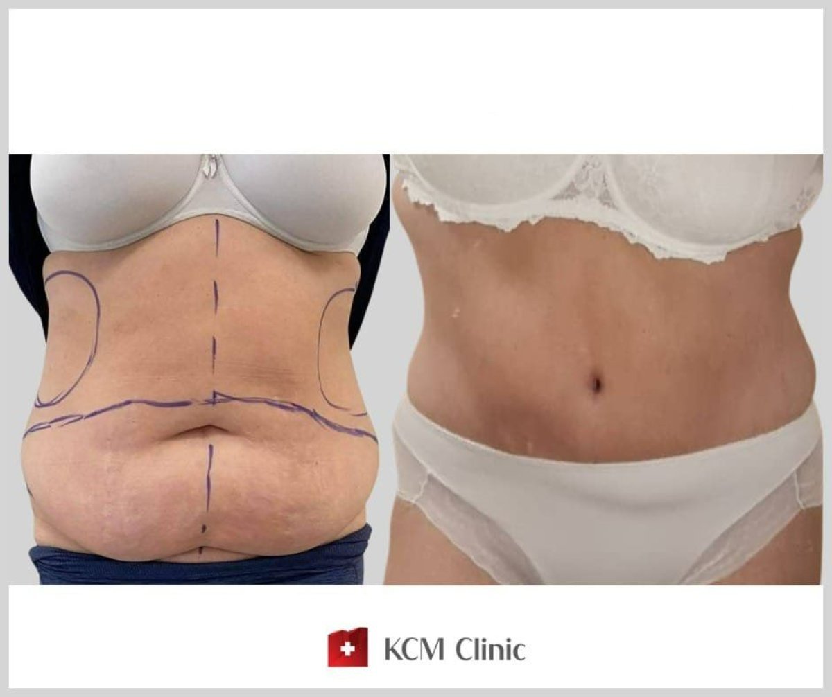 Before and after abdominal liposuction results at KCM Clinic, visible body contour improvement