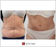 Résultats avant et après liposuccion abdominale à KCM Clinic, amélioration visible du contour