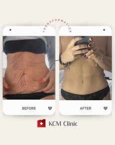 Résultats avant/après de la liposuccion abdominale à KCM Clinic – ventre affiné