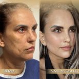 Vorher-nachher-Ergebnis Brauenlifting bei Dr. Safa Manav Clinic, 5 Monate postoperativ