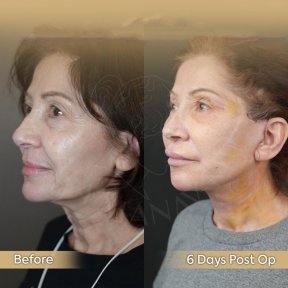 Vorher-nachher-Ergebnis Brauenlifting bei Dr. Safa Manav Clinic, sichtbare Verjüngung