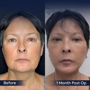 Before and after neck lift results at Dr. Safa Manav Clinic, visible jawline and neck tightening