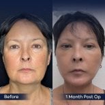 Before and after neck lift results at Dr. Safa Manav Clinic, visible jawline and neck tightening