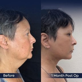 Before and after neck lift results at Dr. Safa Manav Clinic, visible jawline improvement