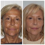Before and after upper and lower eyelid surgery results at Clinica Granado Tiagonce