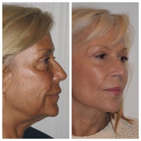 Before and after upper and lower eyelid surgery results at Clinica Granado Tiagonce