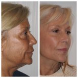 Before and after upper and lower eyelid surgery results at Clinica Granado Tiagonce