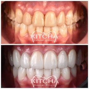 Before and after porcelain veneer results at Kitcha Dental Clinic, smile makeover visible