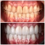 Before and after porcelain veneer results at Kitcha Dental Clinic, smile makeover visible