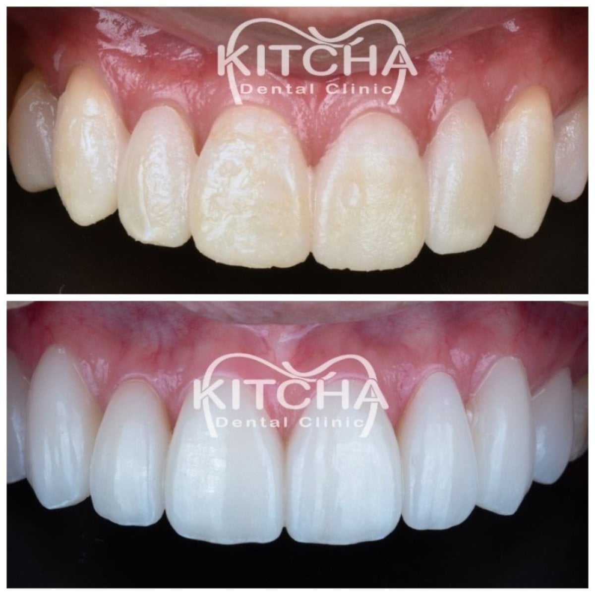 نتائج قبل وبعد عدسات الأسنان الخزفية في Kitcha Dental Clinic – ابتسامة أكثر بياضًا