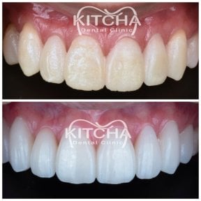 Before and after porcelain veneer results at Kitcha Dental Clinic – whiter, even smile