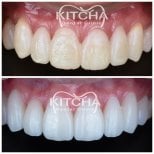 Before and after porcelain veneer results at Kitcha Dental Clinic – whiter, even smile