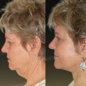 Before and after deep plane facelift results at Memorial Bahçelievler Hospital, facial rejuvenation