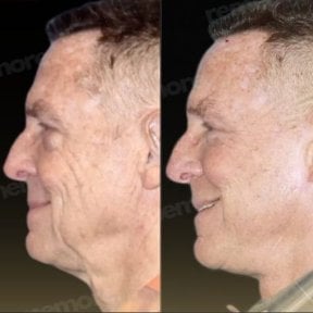 Before and after deep plane facelift results at Memorial Bahçelievler Hospital, facial rejuvenation