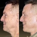 Before and after deep plane facelift results at Memorial Bahçelievler Hospital, facial rejuvenation