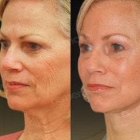 Before and after deep plane facelift results at Memorial Bahçelievler Hospital, facial rejuvenation