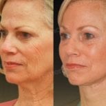 Before and after deep plane facelift results at Memorial Bahçelievler Hospital, facial rejuvenation