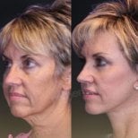 Before and after deep plane facelift results at Memorial Bahçelievler Hospital, facial rejuvenation