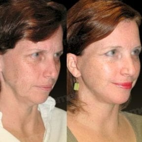 Before and after deep plane facelift results at Memorial Bahçelievler Hospital, facial rejuvenation
