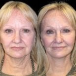 Before and after deep plane facelift results at Memorial Bahçelievler Hospital, facial rejuvenation