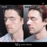 Vorher-nachher-Ergebnisse der Nasenkorrektur bei VG Plastic Surgery, nach 1 Monat