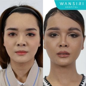 Facelift before and after results at Wansiri Hospital, visible facial rejuvenation effect