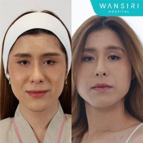 Before and after facelift results at Wansiri Hospital, visible facial rejuvenation outcome